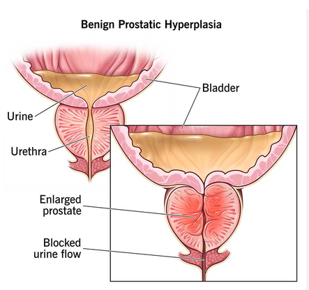 Enlarged Prostate (BPH)